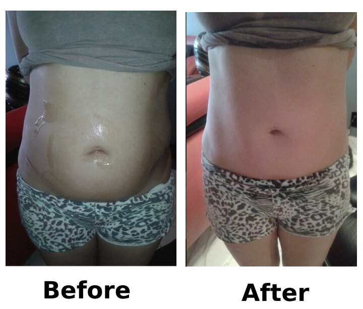MEGA Cavitation : After one treatment